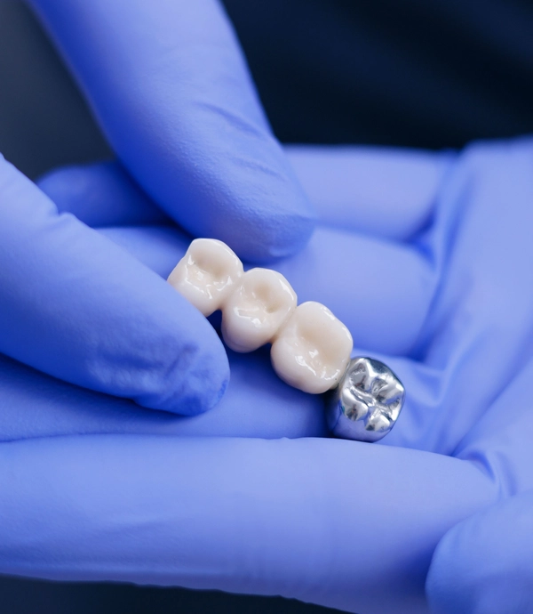 Dental Bridges at Smile Hills Dental