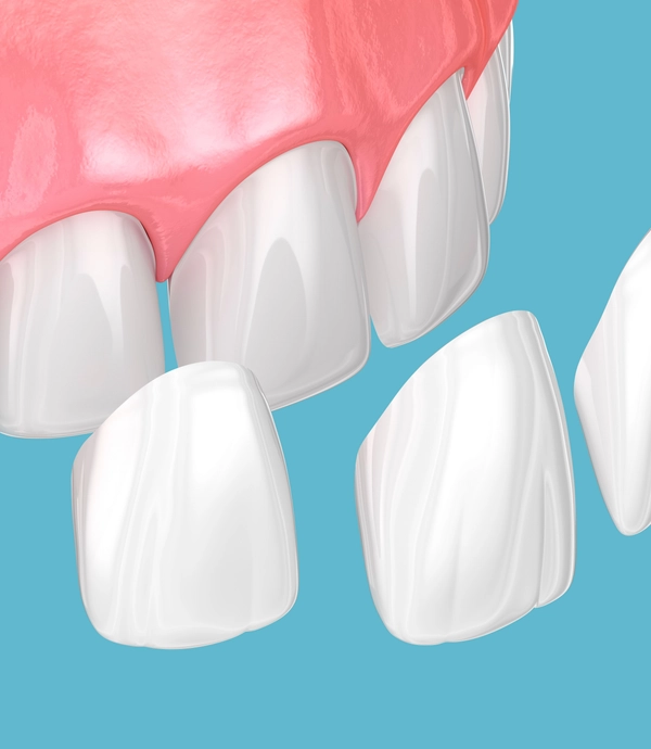 Dental Veneers at Smile Hills Dental