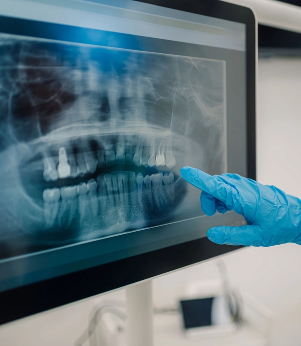 Digital X Rays at Smile Hills Dental