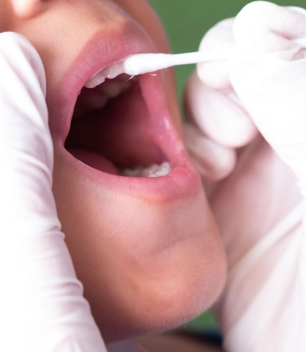 Fluoride Treatment at Smile Hills Dental