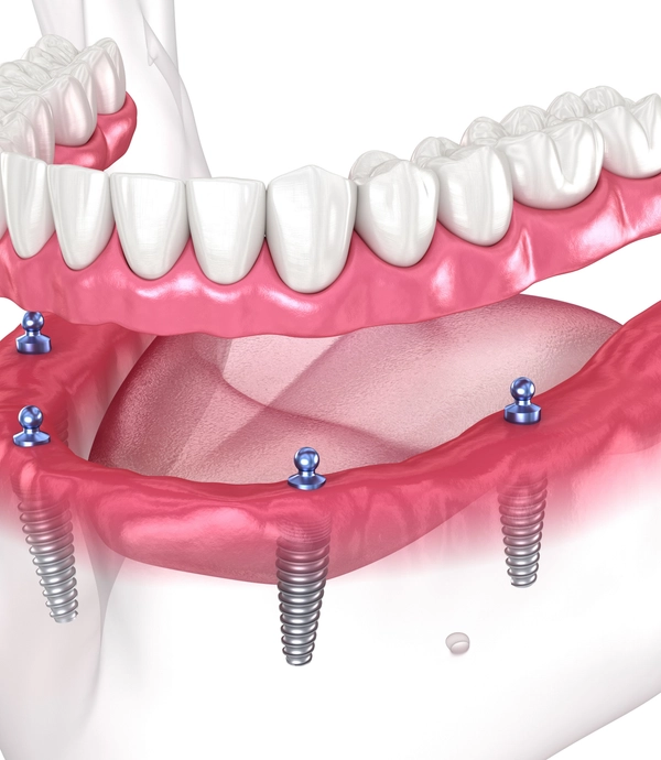 Implant Supported Dentures at Smile Hills Dental
