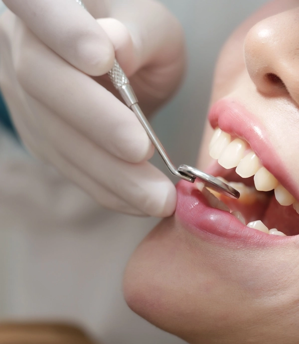 In Office Teeth Whitening at Smile Hills Dental