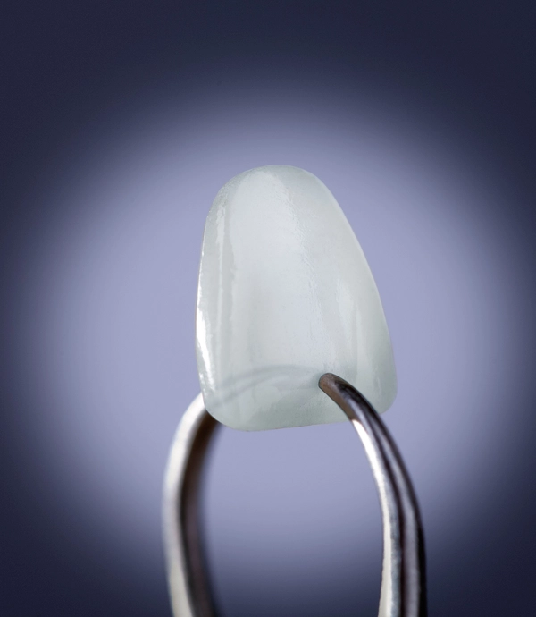 Lumineers® at Smile Hills Dental
