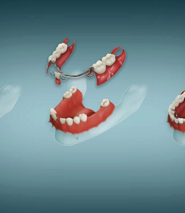 Partial Dentures at Smile Hills Dental
