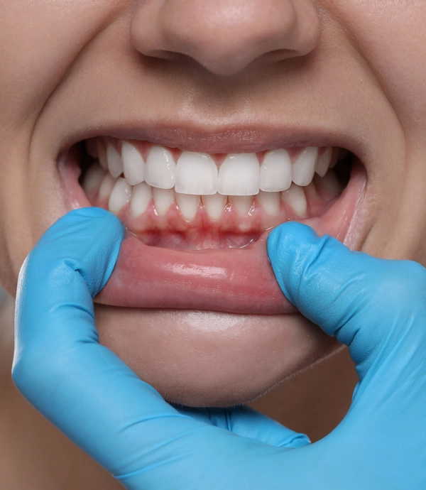 Periodontics services at Smile Hills Dental