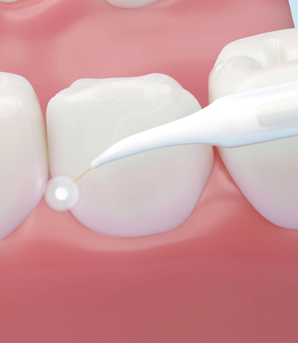soft tissue laser therapy at Smile Hills Dental